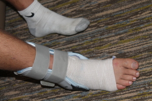 Trevor's ankle cast